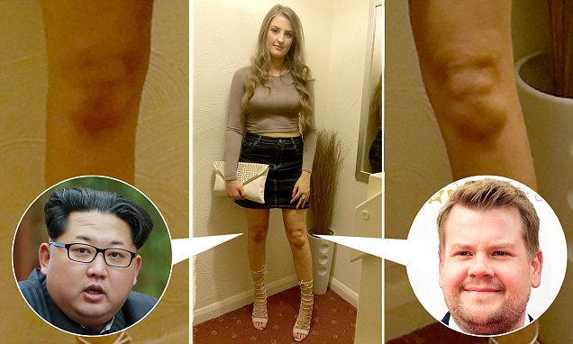 PIC FROM MERCURY PRESS (PICTURED: EMILY DALY, 22 WITH HER LEFT KNEE THAT LOOKS SIMILAR TO JAMES CORDEN AND HER RIGHT KNEE THAT IS THE SPITTING IMAGE OF NORTH KOREAN LEADER KIM JONG UN) An estate agent claims her KNEES look just like British comedy favourite JAMES CORDEN and North Korean dictator Kim Jong Un.   Emily Daly, 22, posed for a photo before a night out on Saturday and was blown away when she spotted her left knee bore an uncanny resemblance to the famous comedian.   Emily, who is a big James Corden fan, said she is bursting with pride after her discovery, and would love for the comedian to see himself on her legs.   On closer inspection she then found that her right knee looked like the face of North Korean dictator Kim Jong Un. SEE MERCURY COPY