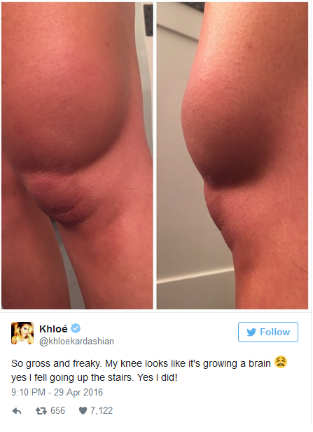 Khloe Bruise