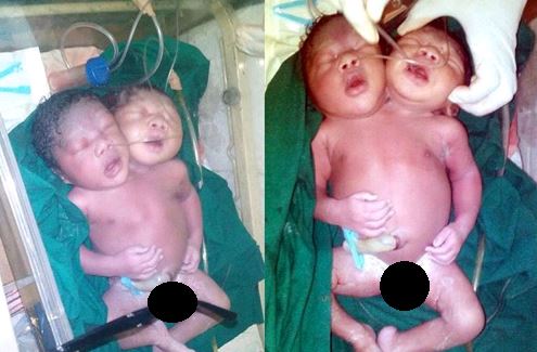 conjoined-twins-born-in-lagos1