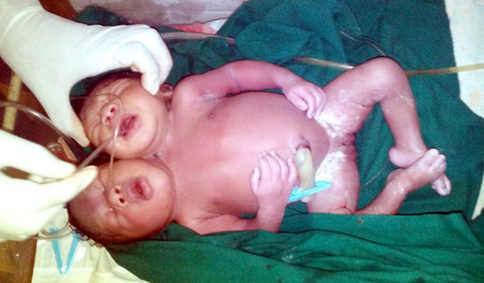 conjoined-twins-born-in-lgaos