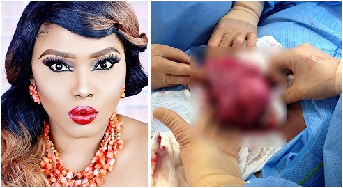 Halima Abubakar undergoes Fibroid removal surgery
