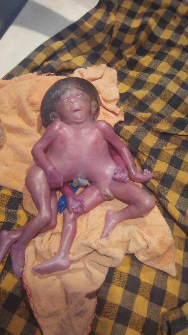 critically deformed baby girl born