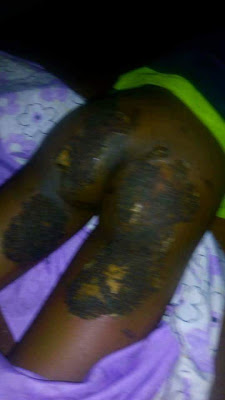 10 year old girl's buttocks burnt