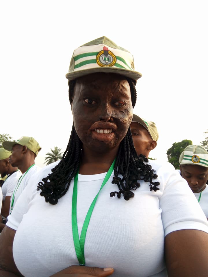 Burn Survivor Attacked