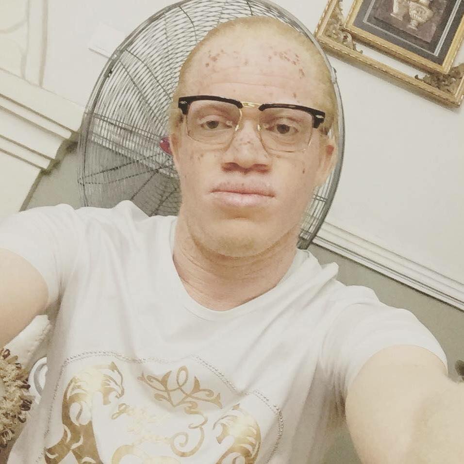 Albino reveals