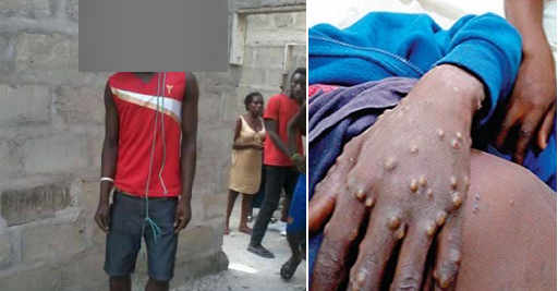 Monkeypox victim commits suicide