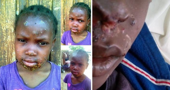 FG Denies Alleged Deliberate Injection Of Monkeypox Virus.
