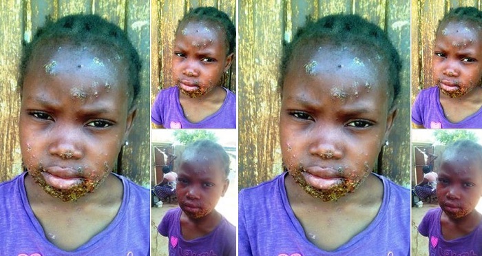 Young Girl Spotted With New Deadly Monkey Pox Disease In Kaduna. (Photos)