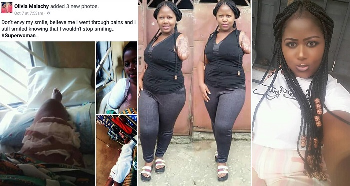 “Believe Me, I Went Through Pains” – Nigerian Lady Shares Story Of How She Lost Her Left Arm In An Accident… Look At How She Looks Like Now! (Photos)