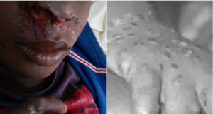 monkeypox hits bayelsa
