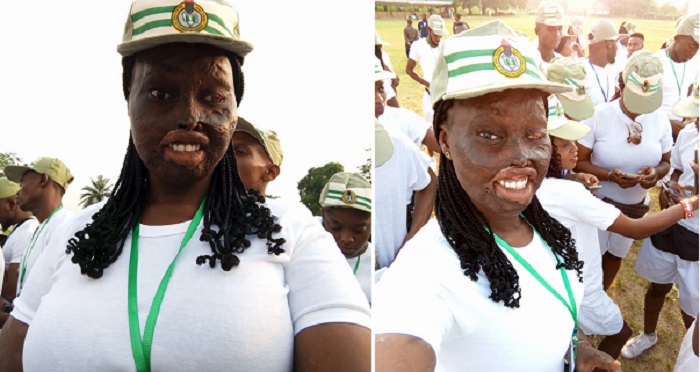 Burn Survivor Who Was Attacked With Acid By Her Uncle’s Wife Starts Her NYSC