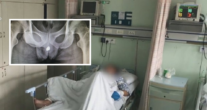 What The?! Man Gets Padlock Stuck In His Bladder After Pushing It Up His P*nis. (Photos)