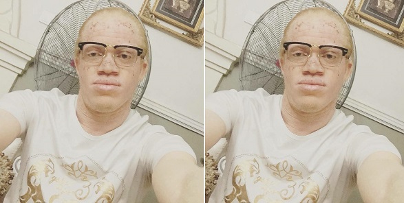 Albino reveals