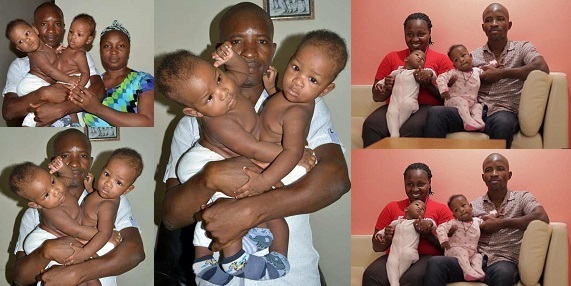 Nigerian conjoined Twins finally gets separated
