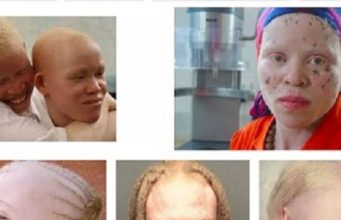Albinos