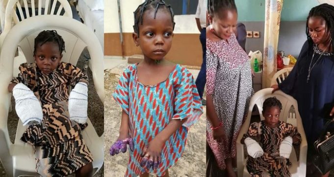 Little girl hands burnt