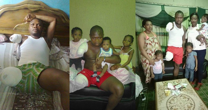 Man who lost his leg and arm in fatal accident reveals why he is happy (Photos)