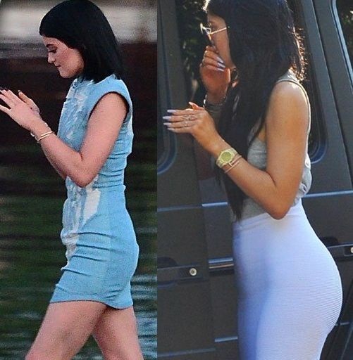 Kylie Jenner Surgery