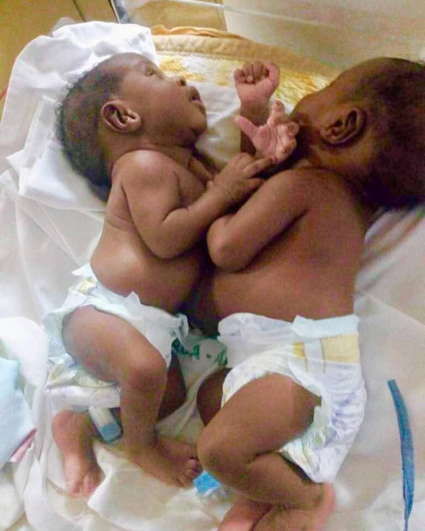 Nigerian doctors separate conjoined twins