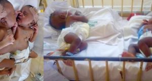 Nigerian doctors separate conjoined twins