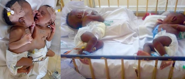 Nigerian doctors separate conjoined twins