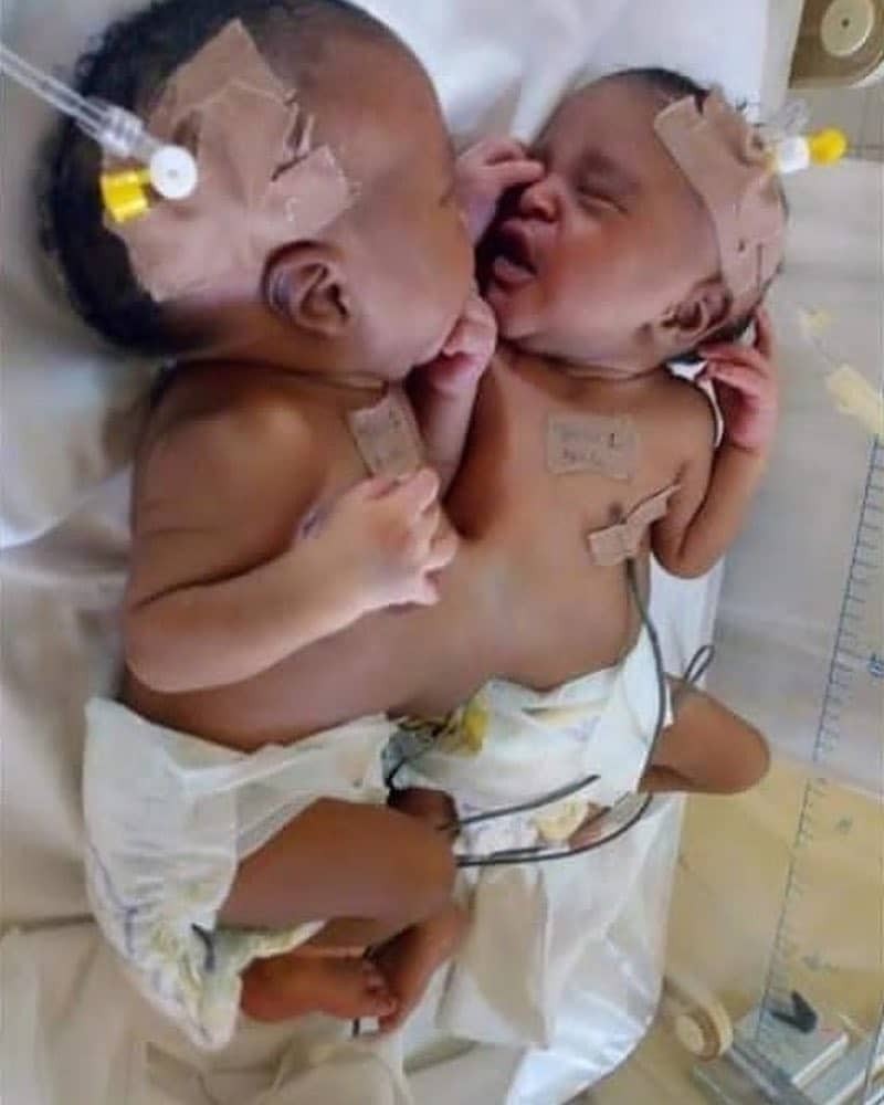 Nigerian doctors separate conjoined twins