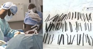 Ethiopian doctors find 122 nails