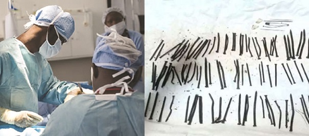 Ethiopian doctors find 122 nails