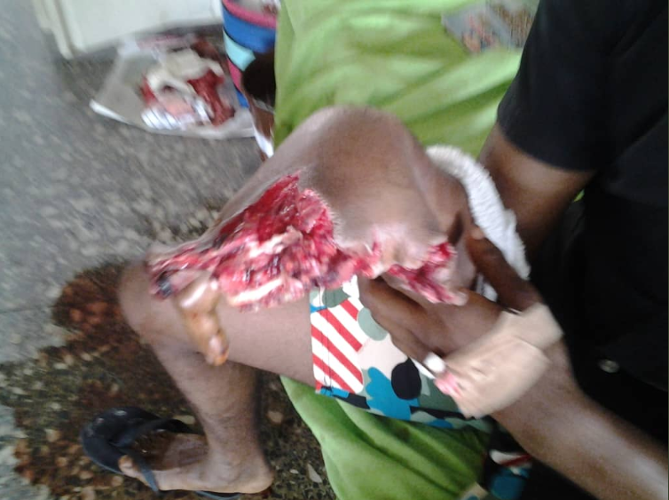UNIUYO student loses his fingers to fireworks