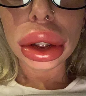 botched lip filler procedure