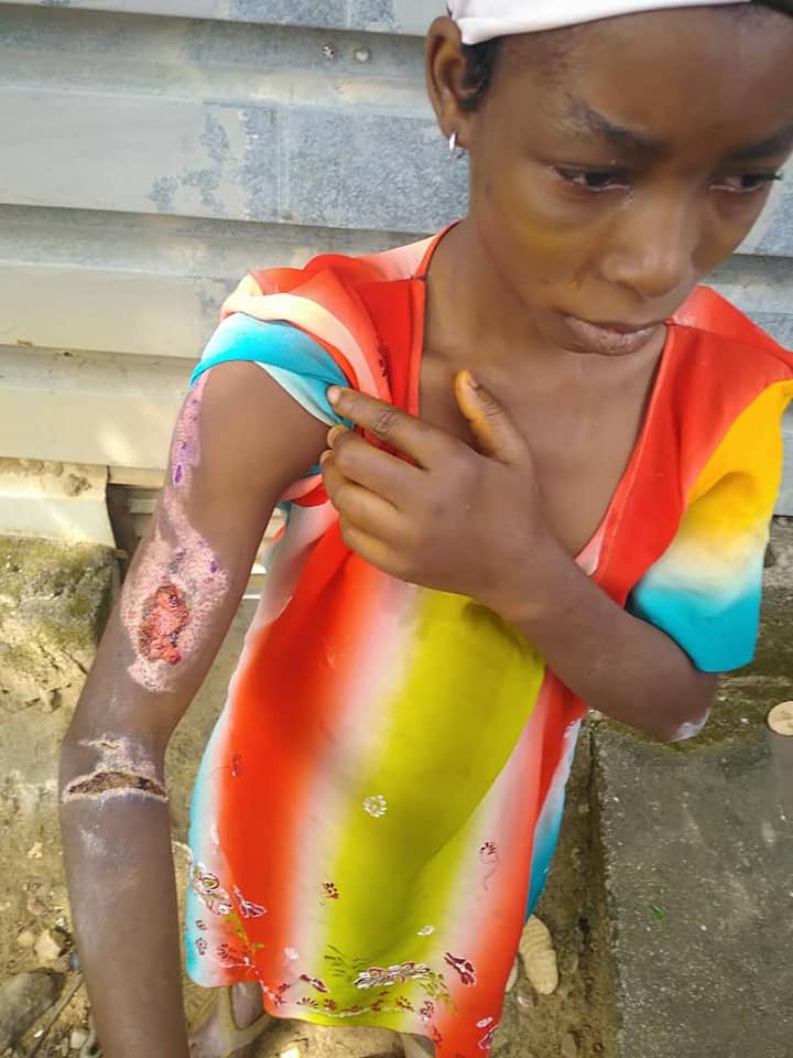 Woman pours hot water on her niece (Graphic Photos) 2