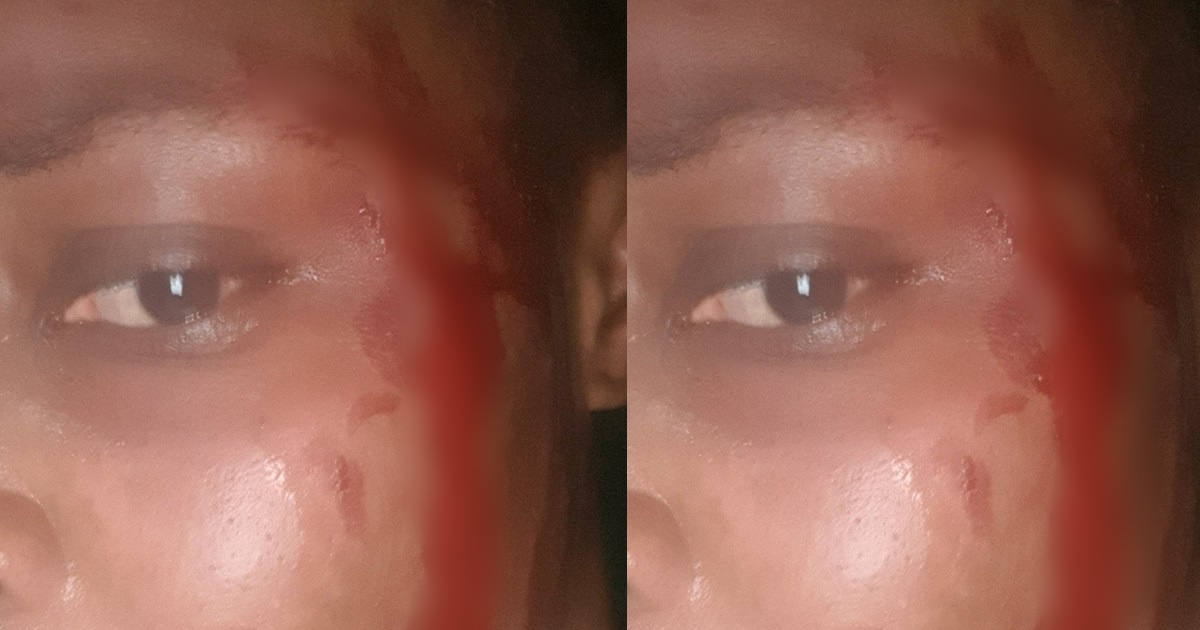 Woman shares how she was macheted by her bike rider and fellow passenger after she refused to part with her purse and phone