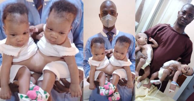 600284dfaccb1 Conjoined female twins separated