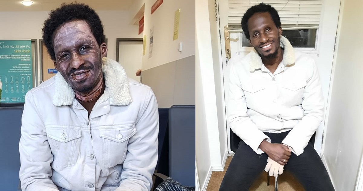 Burn survivor shares photos showing how he started 2020 and how he ended it