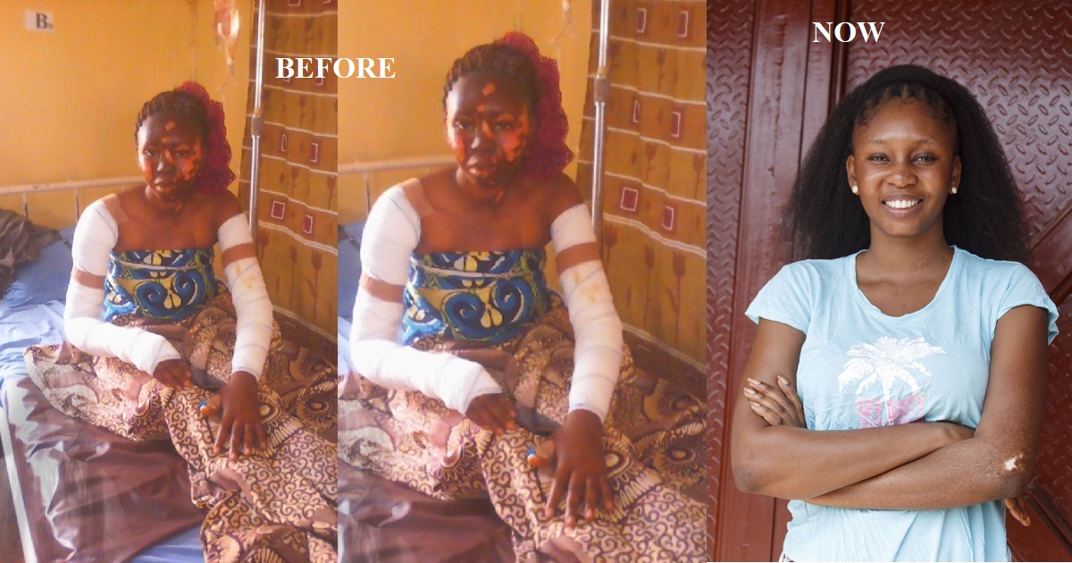 Nigerian chef shares her transformation three years after falling victim of cooking gas explosion