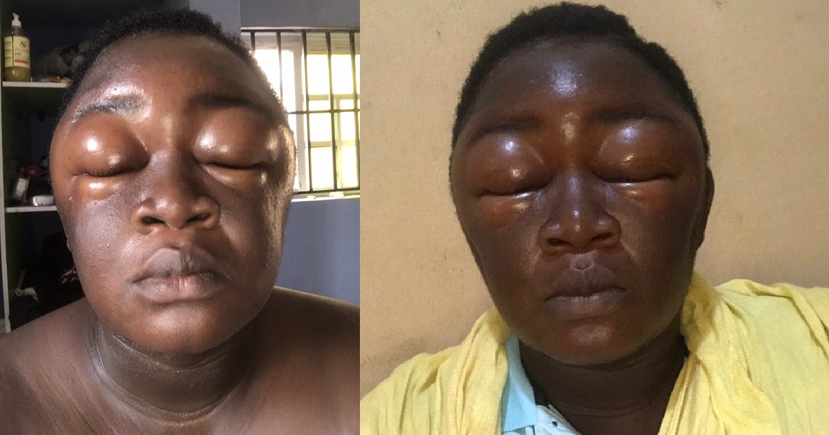 Nigerian woman recounts how she reacted badly to hair dye
