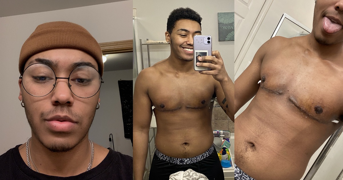 Trans man shows off his chest after undergoing breast removal surgery