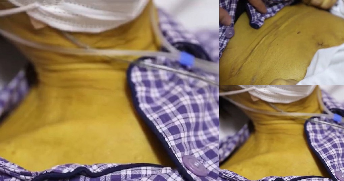 Man’s skin turns bright yellow after over 30 years of drinking and smoking (photos)