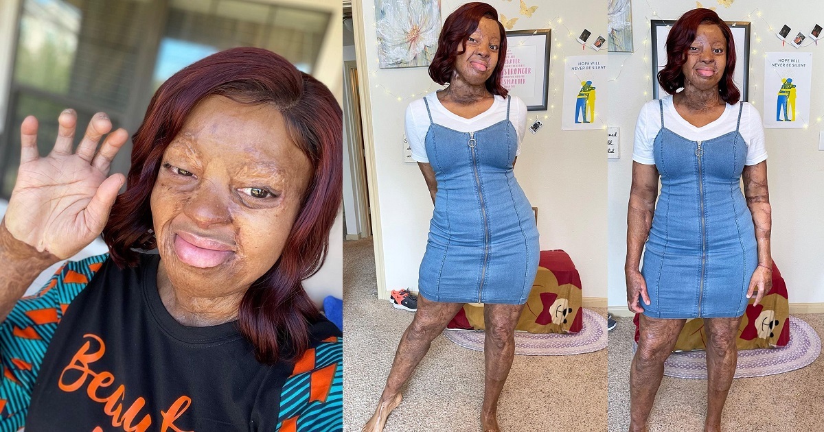 “Show off your scars, people! They’re part of your life story.” — Kechi Okwuchi says as she shares new photos.