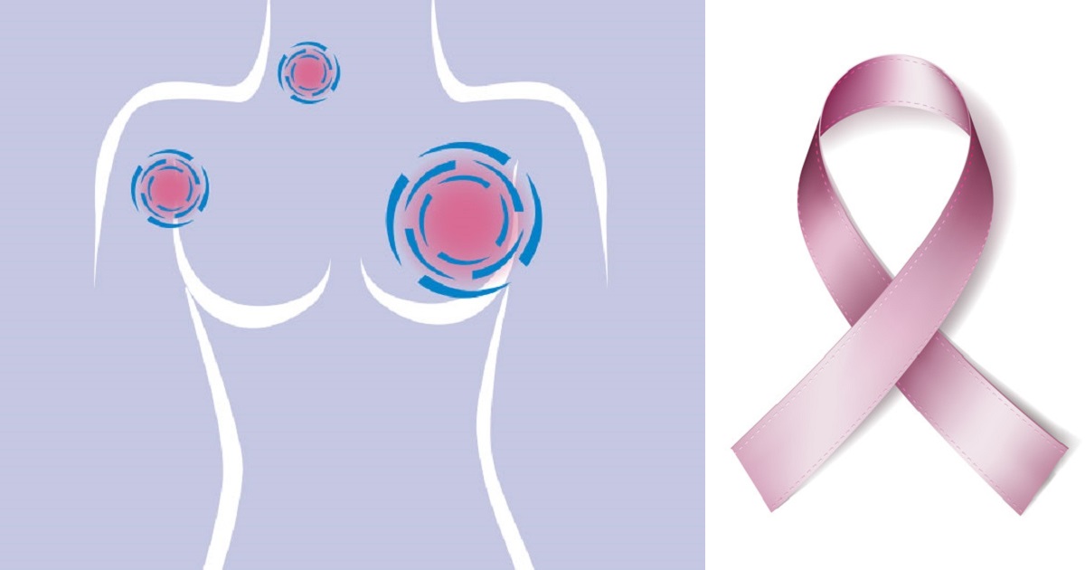 Breast Cancer Awareness: What lifestyle changes can help in the prevention of Breast Cancer?