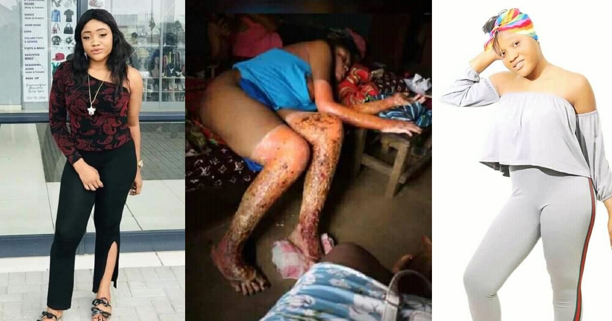 Beautiful young Nigerian woman injured in gas explosion dies