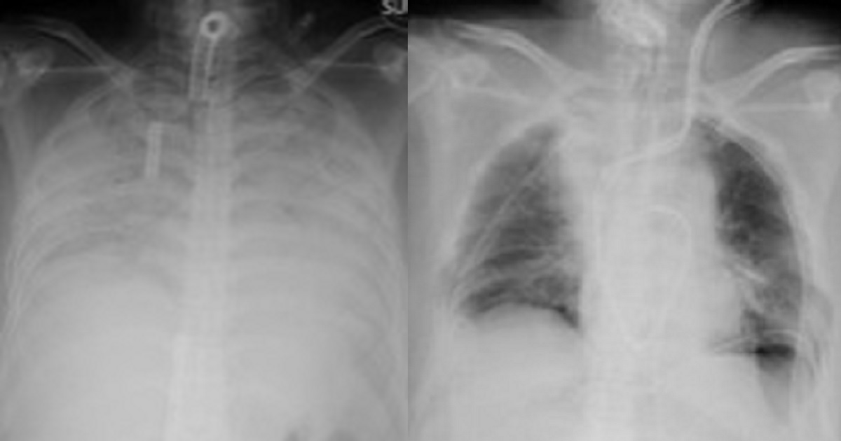 Japanese doctors perform world’s first living donor lung transplant to a Covid-19 patient