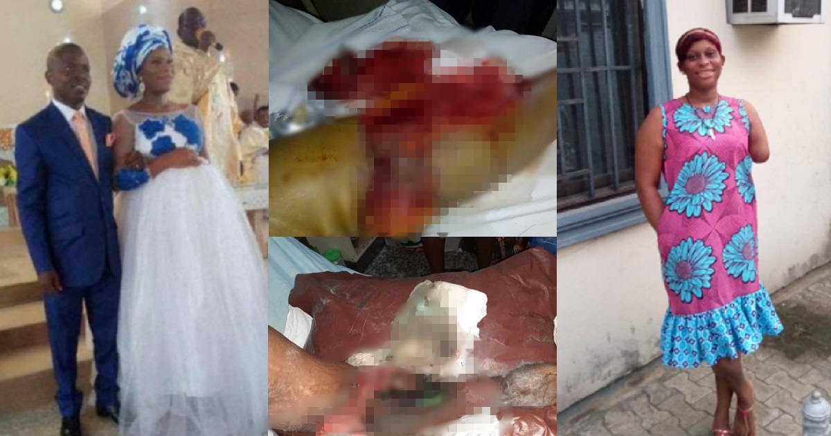 Woman’s arm amputated after her husband allegedly butchered her arm and leg because he suspected her of infidelity (Graphic photos)