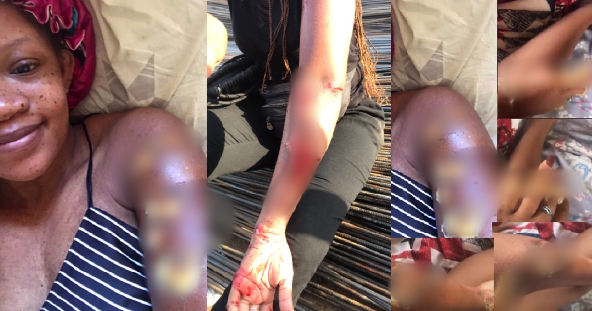 Lady fortunate to be alive narrates how she survived an accident caused by a reckless driver (Photos)
