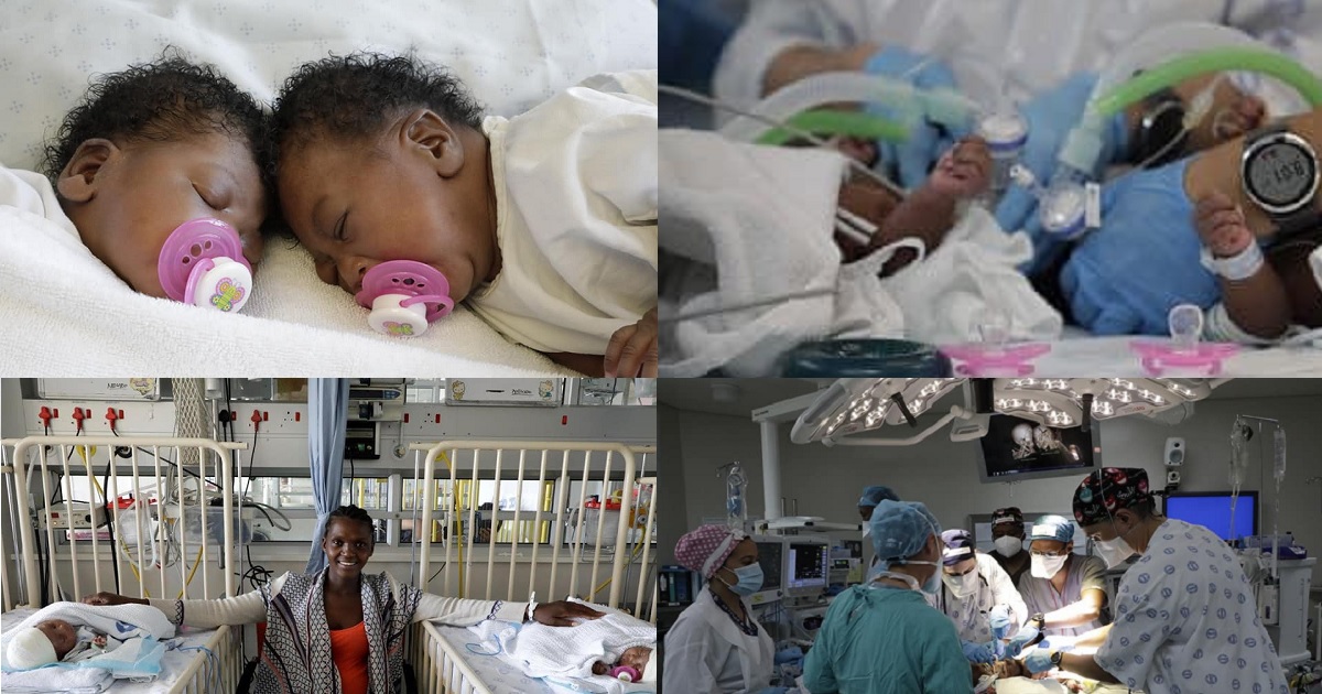 Conjoined twins successfully separated in South Africa (photos)