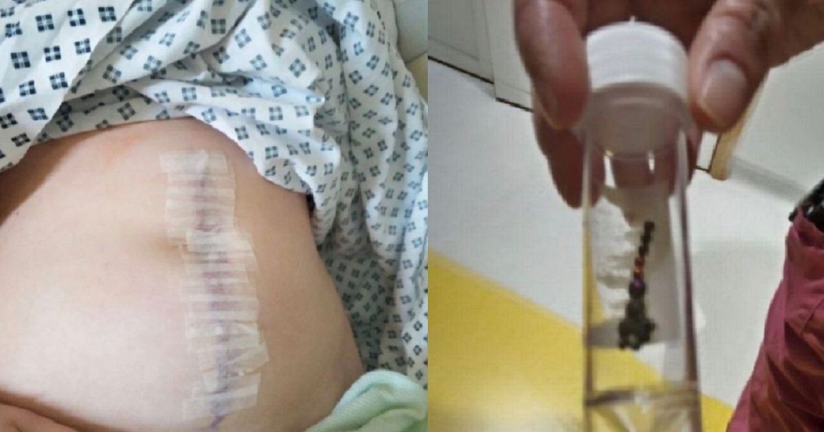 Girl, 13, has her appendix and part of her bowel removed after TikTok trend that nearly led to her death