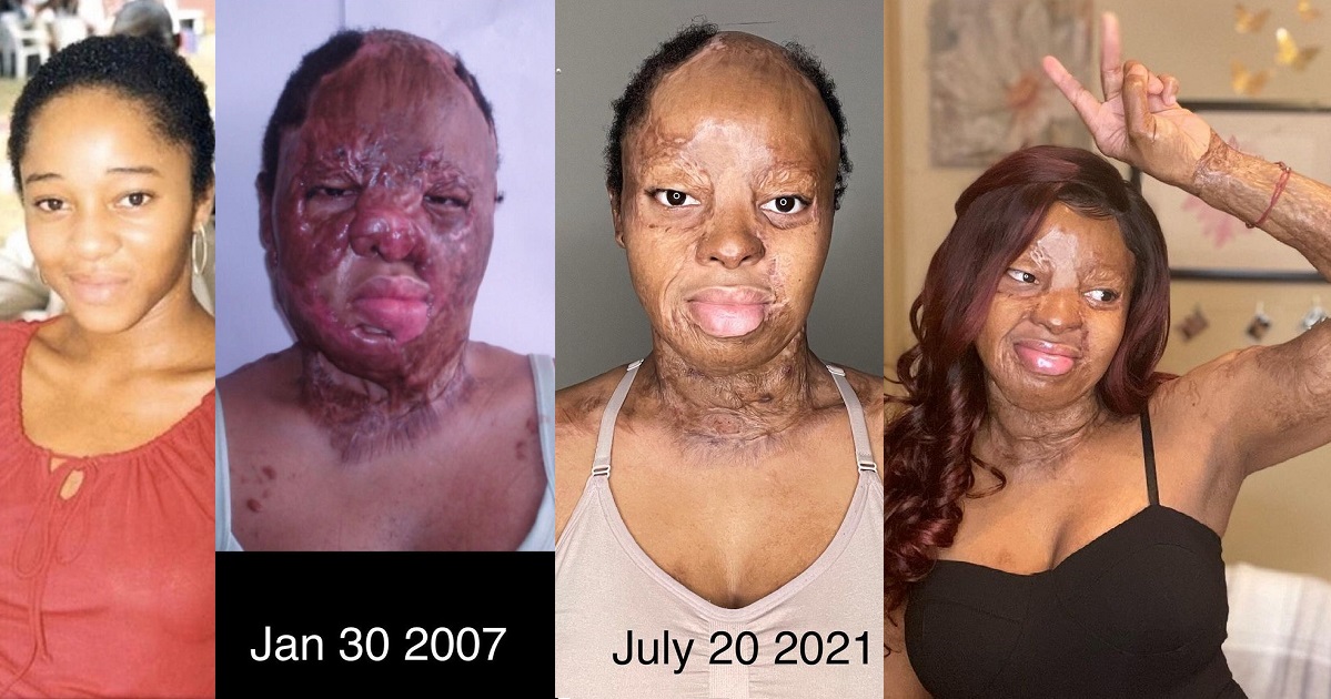 Plane crash survivor and singer, Kechi, shares her Before/After photos as she marvels over how far God has brought her since the incident.
