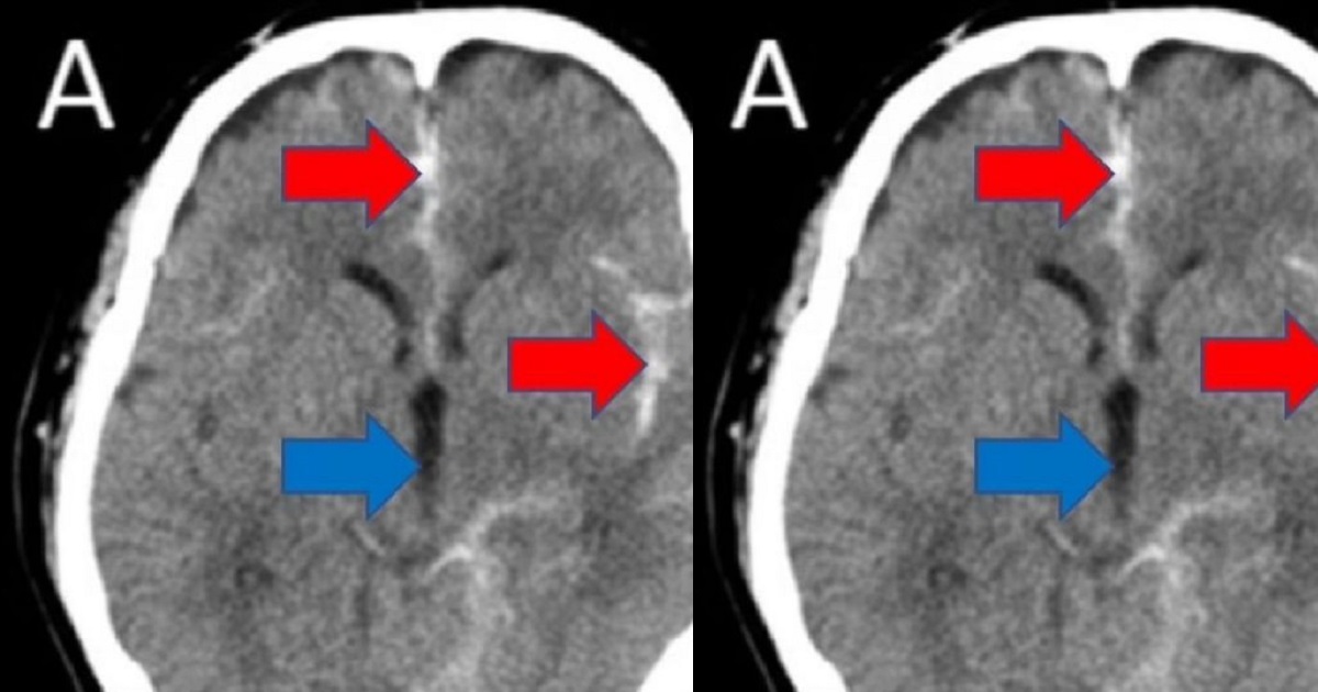 51-year-old man almost masturbates himself to death after suffering stroke as a result of the act