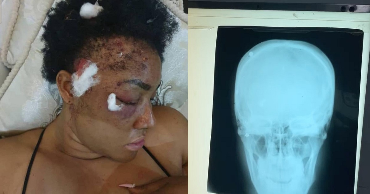 “After 2 years plus, pellets are still coming out” – Actress, Angela Okorie writes as she shows X-ray of her head years after she was shot (video)