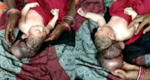 Three-headed baby hailed